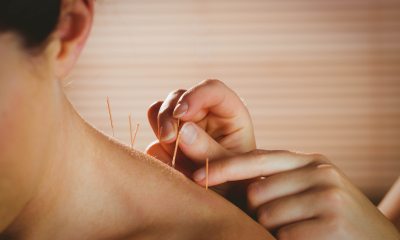 Close-up of an acupuncturist treating a patient's bare shoulder