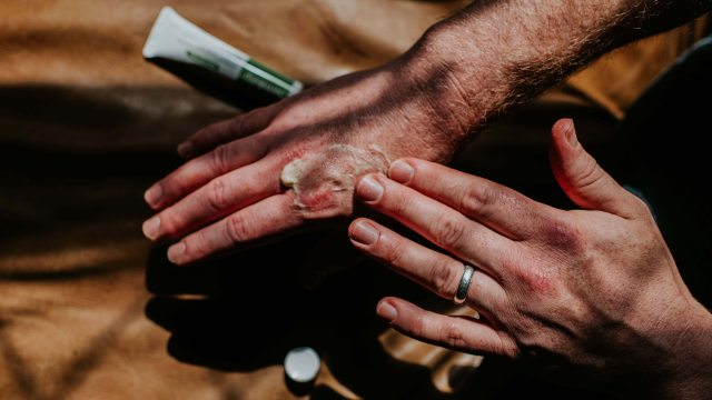 Close-up of someone's hand rubbing ointment into small burn on the other hand