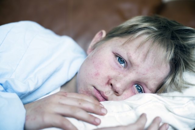 School aged white child sick with measles rash lying in bed